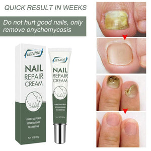 Boxania® Eelhoe Nail Treatment Repair Gel, Toe Be Health Instant Beauty Gel, Restores Appearance Of Discoloured Or Damaged Nail 20g