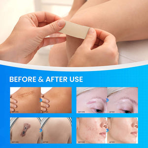Patcheal™ 4 Pcs Silicone Scar Removal Sheets 5.7" x 1.57", Scar Prevention and Treatment, Fast & Effective on C-section,Surgical Scars Keloids, Reusable and Washable